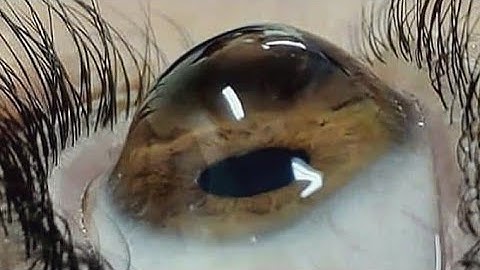 Keratoconus (KC)  And Treatment