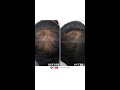 Androgenetic alopecia results   dr nivedita dadus dermatology clinic