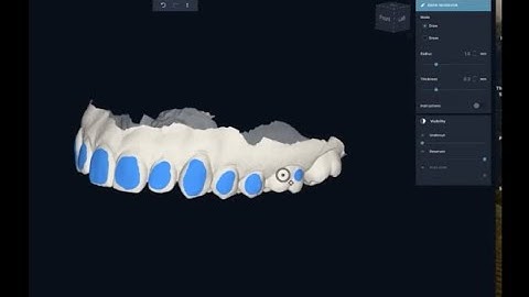 Shannon Pace on 3D printed whitening trays