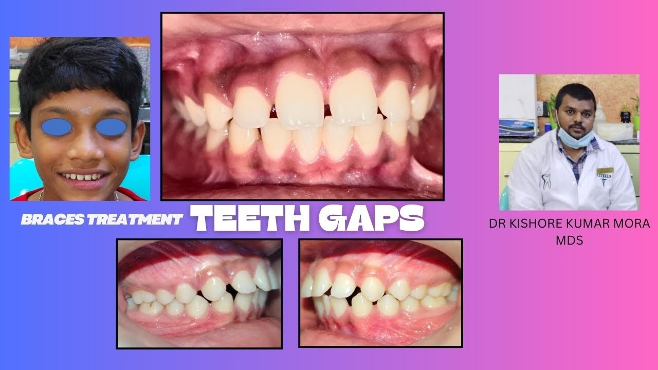 Braces for Teeth Gaps # Gap Closure with Braces # Closing Gaps with Braces #  Teeth Spacing 