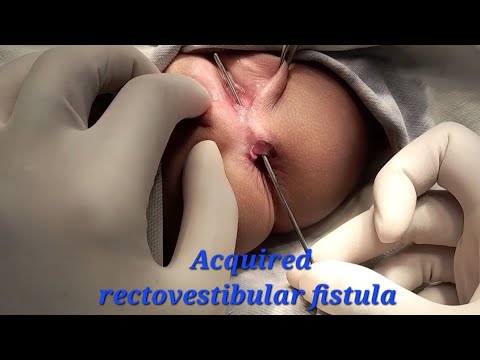 Acquired rectovestibular fistula resection in a female child / How do I do it