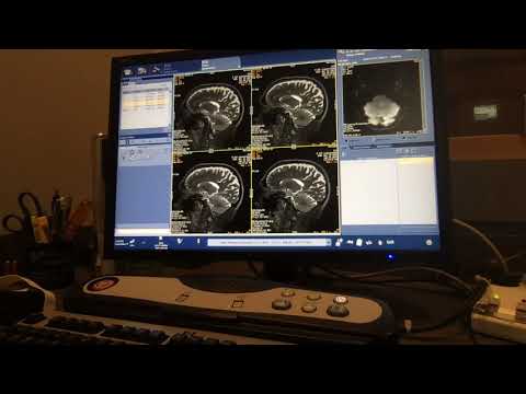 Video: Hoe We Lezen: Het Gecombineerde Gebruik Van MRI En Nieuwe PET-tracers Voor De Karakterisering En Behandelingsplanning Van Massa's In Neuro-oncologie