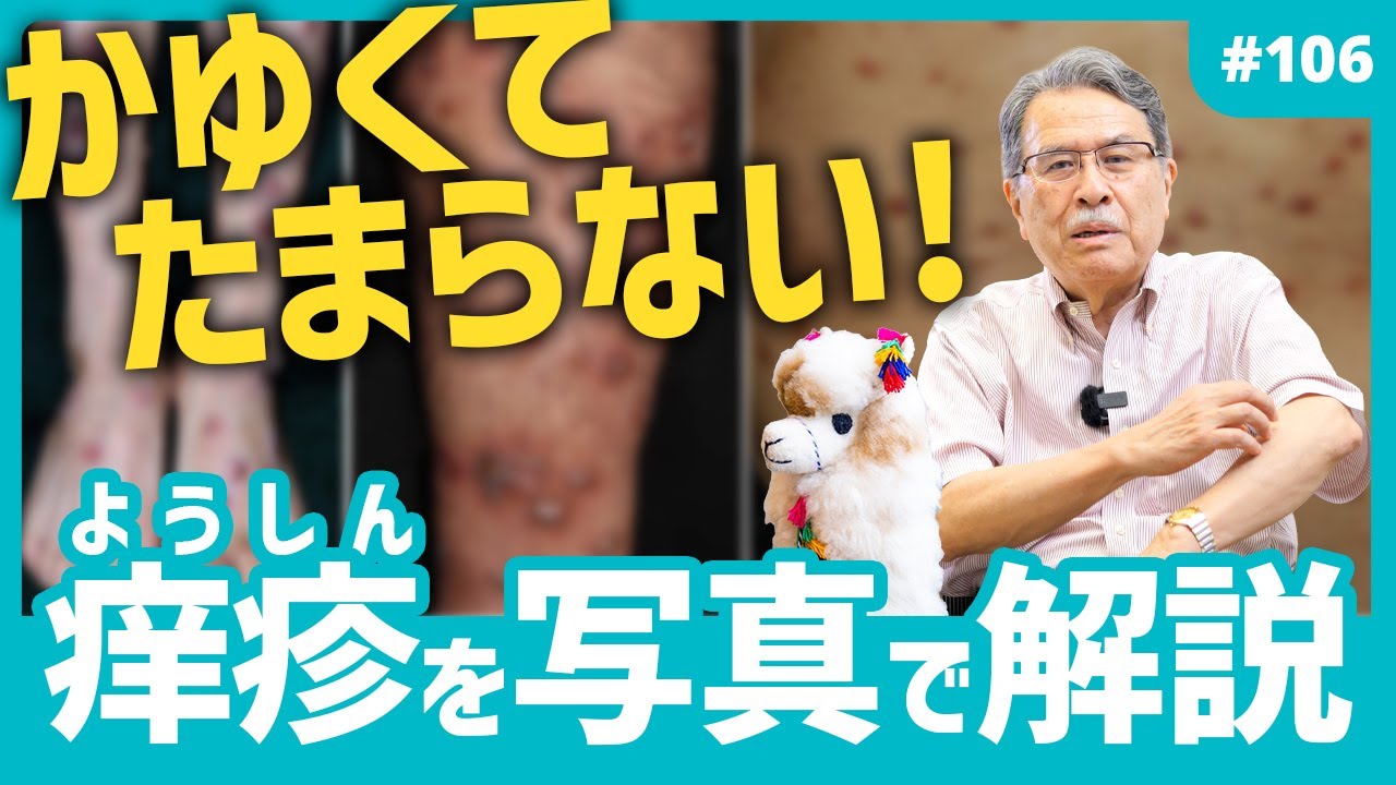 第106話 かゆくてたまらない！痒疹(ようしん)を写真で解説【痒疹(ようしん)の治療①】