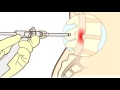 Hernia discal qu es cmo se opera  neurociruga torres