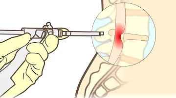 ¿Qué hace un cirujano en caso de hernia discal?