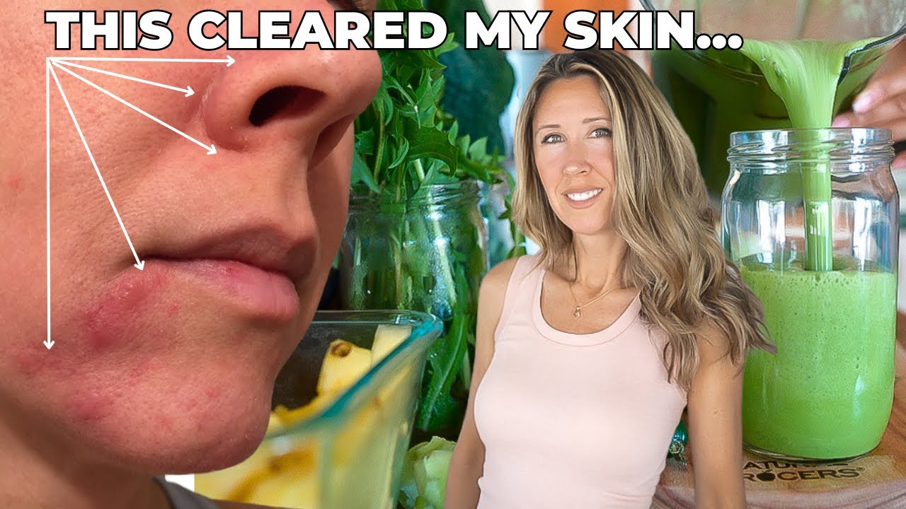 How I Cleared My Skin Naturally - YouTube