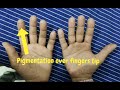 PEUTZ JEGHERS SYNDROME