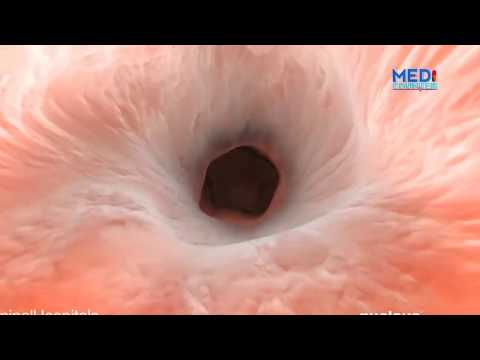 Video: Je saratani ya tezi dume husababisha teratoma?