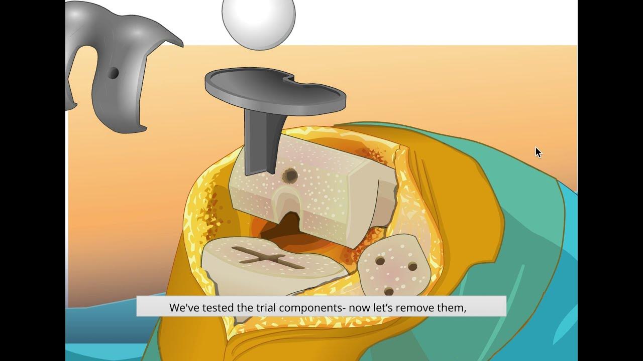 Edheads Virtual Knee Surgery YouTube