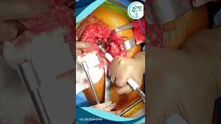 Total Hip Replacement, Hip Joint Surgery, Joint Pain Treatment In Vesu, Surat.