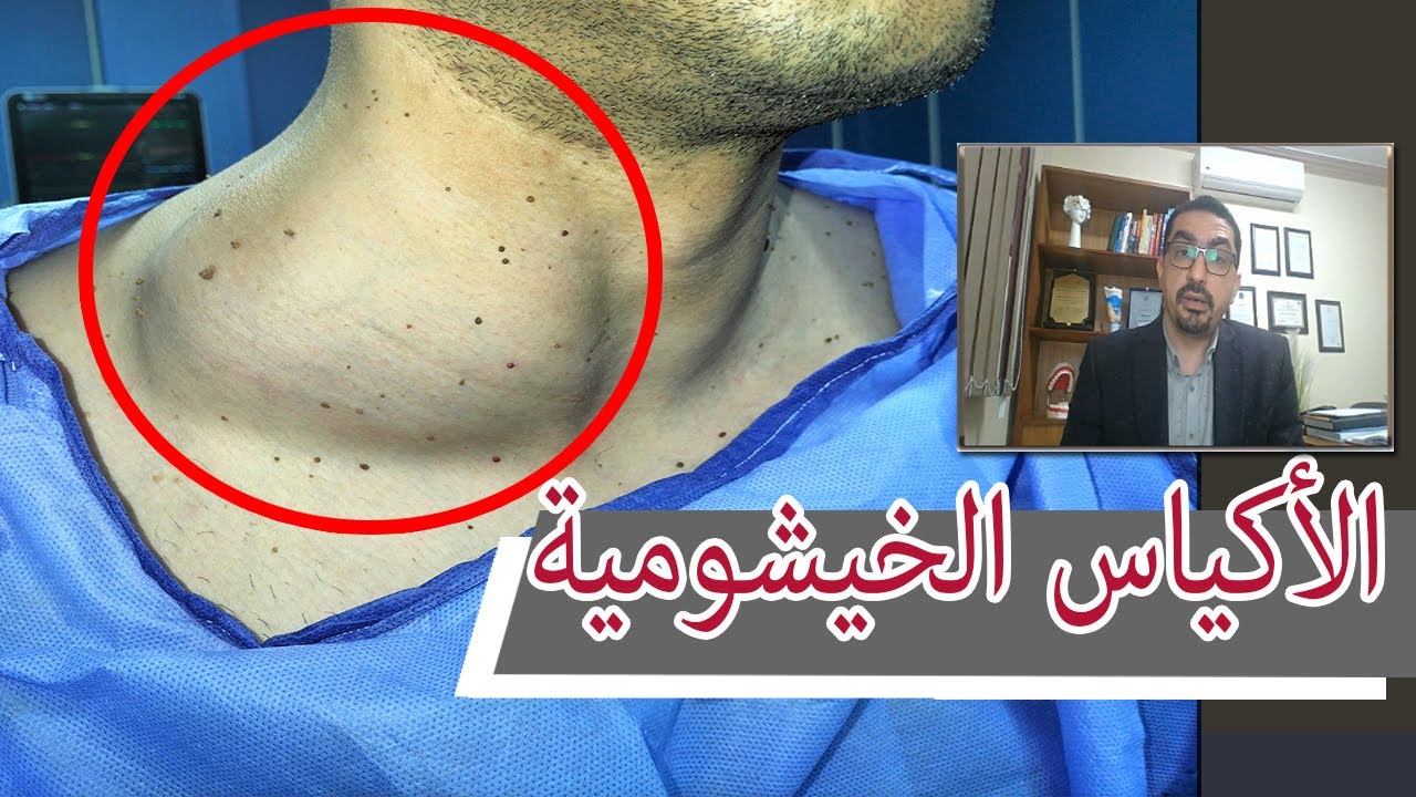 أشهر أكياس الرقبة .. الأكياس الخيشومية بالرقبة (1)