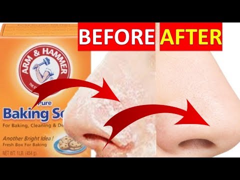 Video: Baking Soda For Blackheads: Mengapa Anda Harus Menghindarinya Dan Apa Yang Harus Dilakukan