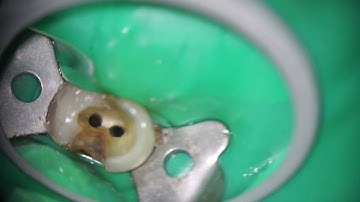 Dr. Jenner performing a root canal with the Seiler Alpha Air Microscope