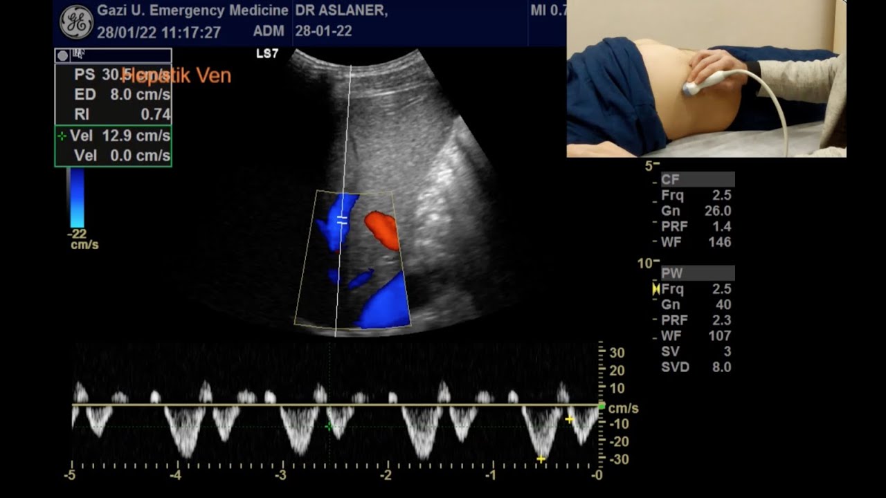 Venöz Yüklenme Ultrason Skoru (VExUS)