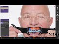 Same day digital denture