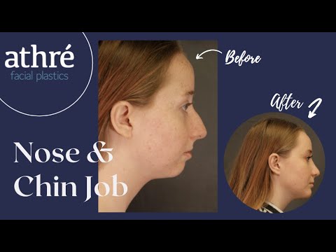 Chin Augmentation + Nose Job (Ultrasonic Rhinoplasty) BEFORE & AFTER