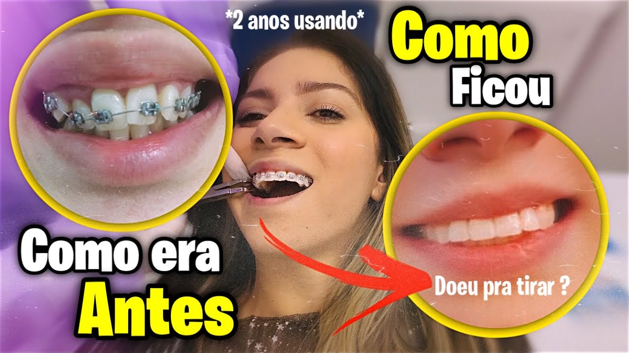 TIRANDO O APARELHO DEPOIS DE 2 ANOS | MOSTREI TUDO *doi pra tirar ?*