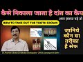 कौन सा तरीका है अच्छा और सेफ दांत का कैप अगर निकलना पड़े तो -TOOTH CAP removal safe method-Dr.Bhatia