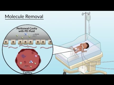 "Peritoneal Dialysis" by Sharon Su for OPENPediatrics