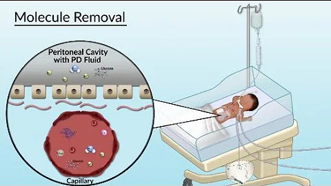 "Peritoneal Dialysis" by Sharon Su for OPENPediatr...