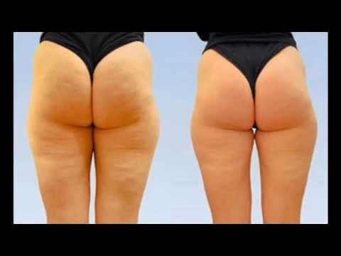 эвелин антицеллюлитный крем отзывы - YouTube