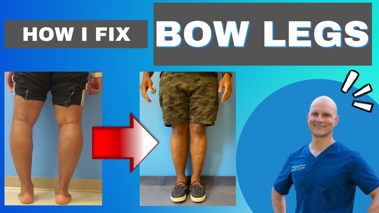 The ONLY way to Fix Bow Legs! Get the Facts YouTube