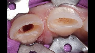 Partial Pulpotomy , Cvek Pulpotomy, Calcified Dentin Bridge, Dental Trauma, NeoPutty