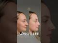 Nose Filler Before & After: Can It Really Replace Surgery? | #EnfieldRoyalClinic