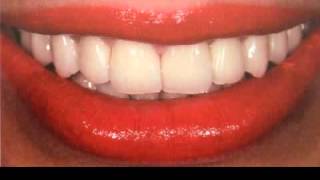 Tooth Color Selection for dentures