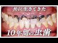 【虫歯治療】共に生きてきた10年間の虫歯