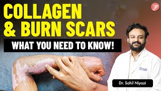 How Collagen Heals Burn Scars Role of Collagen in Scar Healing Dr Sahil Niyazi SB Aesthetics