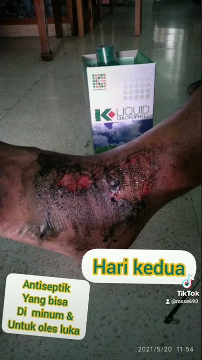 Klorofil K-Link Untuk Luka Sangat Bagus Dan Aman WA 082287351494