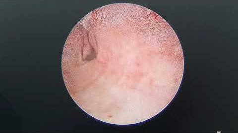 61 tuổi, còn 1 quả thận, lại bị tắc do sỏi, làm thế nào? 22/7/21. Ts.Bs.Dương Văn Trung 0913534343