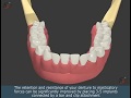Implant supported denture scenario 3  smile guru