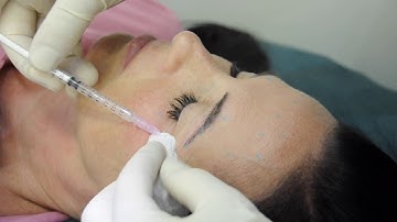 Botox Marking and Injection