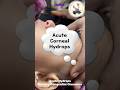 Eye problem in children #glaucoma #hydrops #cornea #eyecare #childhealth #english
