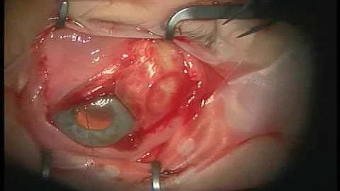 Dr Anup Khatana Bleb Revision -Application of Amni...