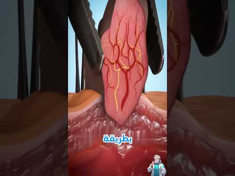 لا تزل العلامات الجلدية بنفسك هذا ما قد يحدث لك