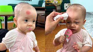 Kim's mother was worried when saw her forehead was red and swollen