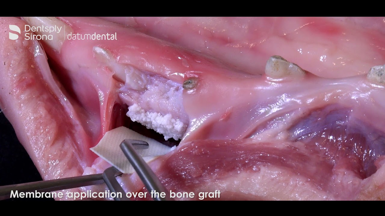 Ridge Augmentation demonstration with OSSIX Plus