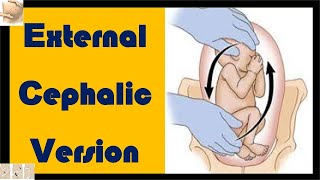 External Cephalic Version (ECV)  | How to Flip a Fetus? | How to Turn a Breech Baby? screenshot 5