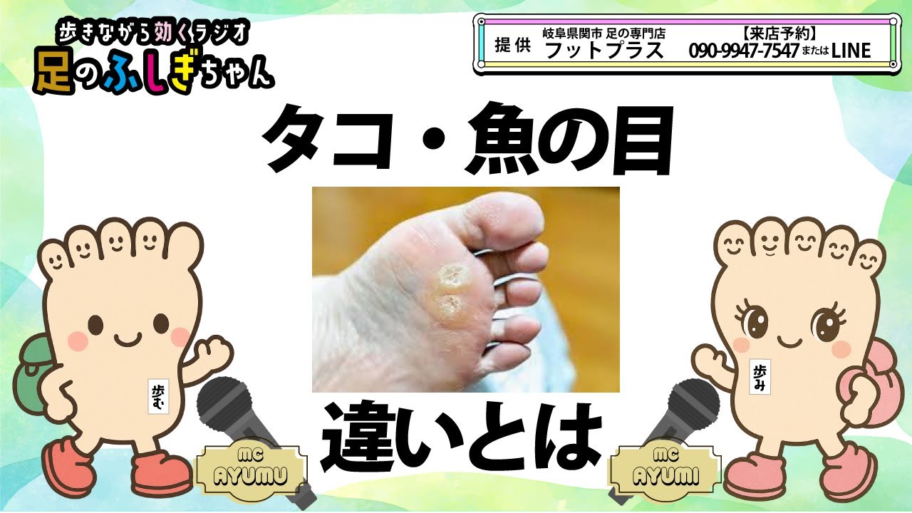 タコと魚の目の違いとは (足の専門店 フットプラス #岐阜県 関市) #美容 #姿勢改善 - YouTube