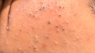 Part 1 Tag skincare removal blackheads