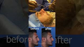 Operating Room Review A Successful Rhinoplasty And Septoplasty Revealed