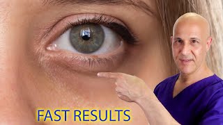Remove Eye Bags, Dark Circles, Acne and Get Clear Skin Naturally!  Dr. Mandell
