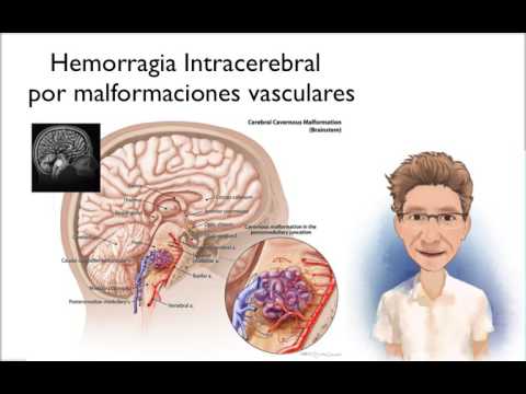 Video: A largohet hemorragjia intraventrikulare?