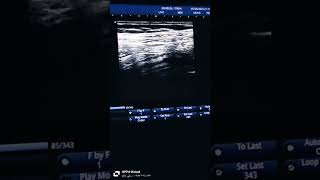 Appendicitis ultrasound and pitfalls of appendicitisهنشوف ازاي نقرر الزايده ملتهبه والا كبيره فقط