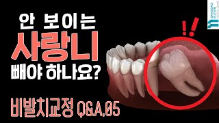 안 보이는 사랑니, 빼야 하나요?? 비발치교정Q&amp;A★ 5탄!