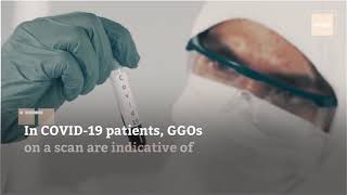 What Do 'Ground Glass Opacities' Mean in Lung Scans of COVID-19 Patients?