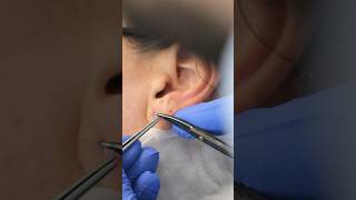 Ergebnis Nach Ohrlochkorrektur Üsseldorf